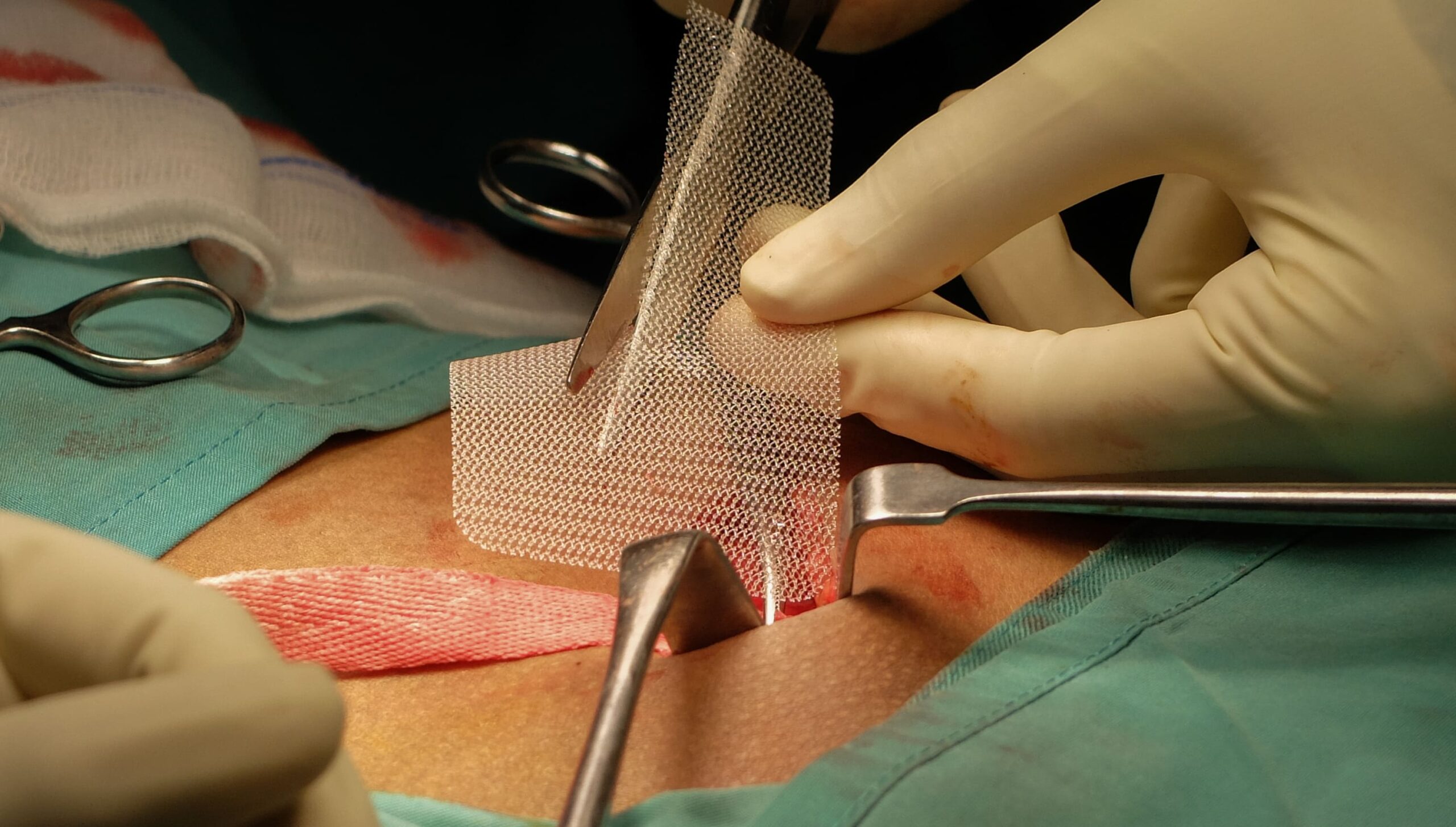 Surgeon implanting a hernia mesh during surgery. Hernia mesh implants have been linked to complications such as infections and chronic pain, leading to lawsuits.